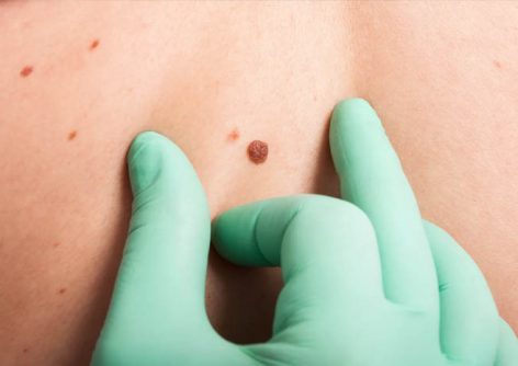 Types of skin moles and how to know if they’re safe
