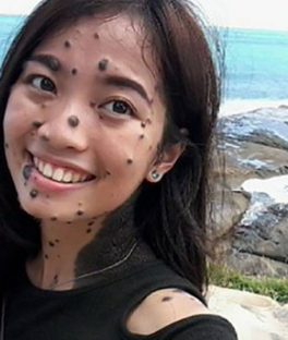 Woman Born With Moles All Over Her Body Is Trying Out for Miss Universe