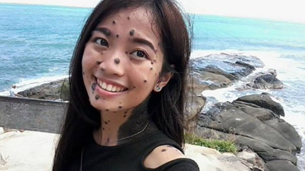Woman Born With Moles All Over Her Body Is Trying Out for Miss Universe