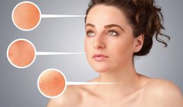 What Type of Acne Do You Have? Types of Acne Explained