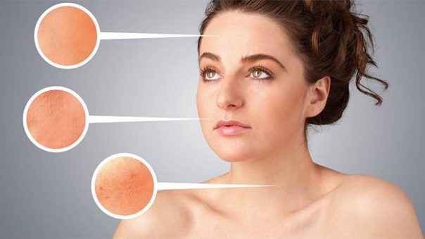 What Type of Acne Do You Have? Types of Acne Explained