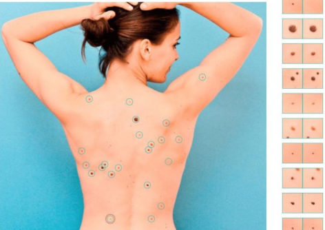 Mole mapping – what is it and how to get your moles mapped?