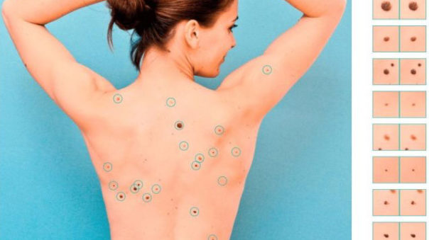 Mole mapping – what is it and how to get your moles mapped?