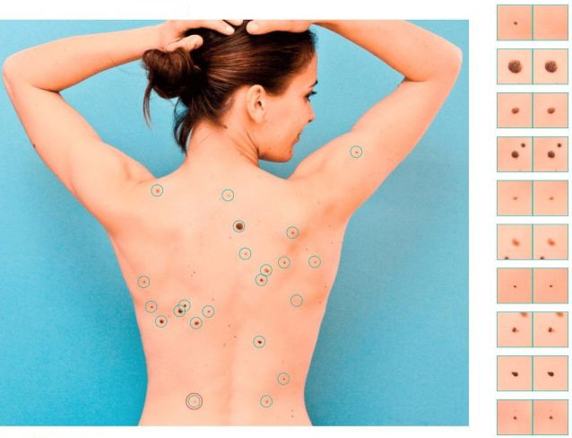 Mole mapping – what is it and how to get your moles mapped?